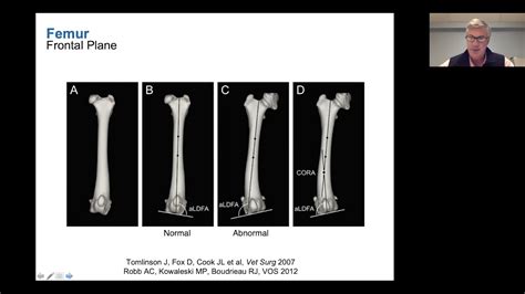 Distal Femoral Osteotomy: Indications, Planning and Surgical Technique - YouTube