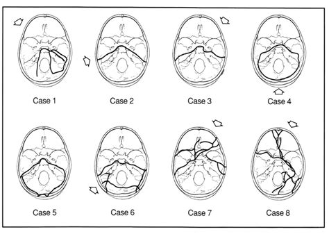 -Section through an unfractured temporal bone in the plane of fracture ...