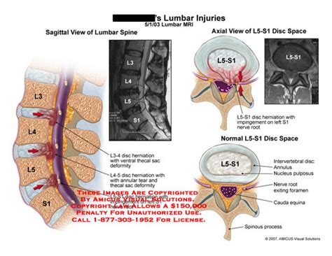 AMICUS Illustration of amicus,injury,lumbar,disc,herniation,L3-4,L4-5,L5-S1,impingement,nerve ...