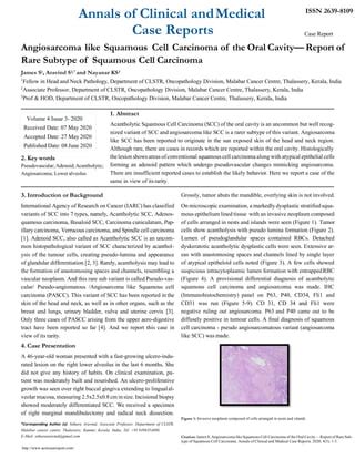 Angiosarcoma like Squamous Cell Carcinoma of the Oral Cavity – Report of Rare Subtype of ...