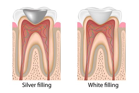 Tooth Fillings Atlanta GA | Midtown Dental Fillings