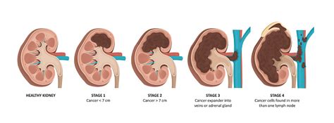 Kidney Cancer Stages Stock Illustration - Download Image Now - iStock