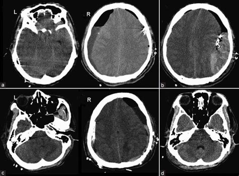 (a) Immediate postoperative CT scan after bilateral burr hole drainage ...