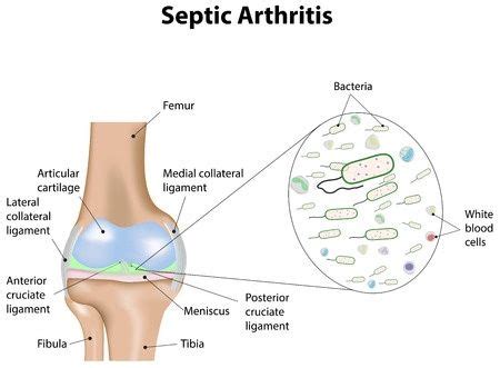 Failed Diagnosis of Sepsis Results in Amputation