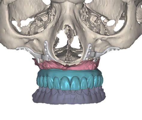 Implantes Subperiósticos - Instituto Maxilofacial Implantes ...