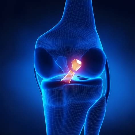 ACL Tears vs PCL Tears - Colorado Center of Orthopaedic Excellence