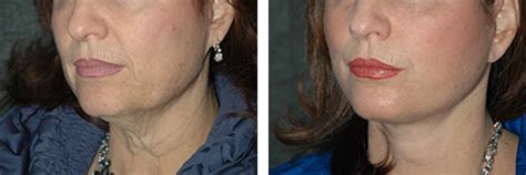 Platysmaplasty | Platysmaplasty Before and After Photos