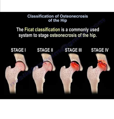 Ficat Classification for Osteonecrosis of The Hip — OrthopaedicPrinciples.com