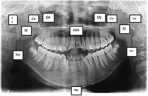 Landmarks used in orthopantomograph Figure 5: Planes to be used for for... | Download Scientific ...