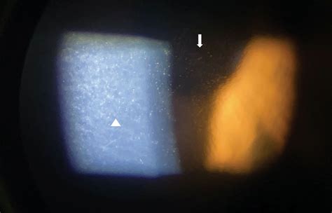 The Consequences of Corneal Endothelial Compromise