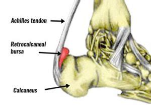 Achilles Bursitis | Retrocalcaneal Bursitis - Symptoms, Causes & Treatment