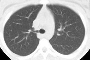 Term of the day : "Pig Bronchus" - Sumer's Radiology Blog