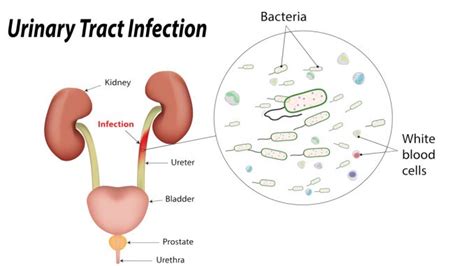 Pyuria – Drug Details