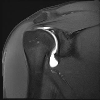 Rotator Cuff Tear Mri Arthrogram - cloudshareinfo