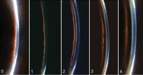 Sharpen Your Slit Lamp Technique