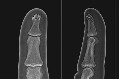 FINGER DISTAL PHALANX FRACTURES | Hand Surgery Resource