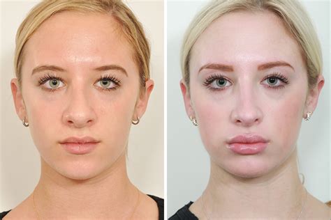 Rhinoplasty-236