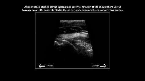 Glenohumeral joint effusion on shoulder ultrasound - YouTube