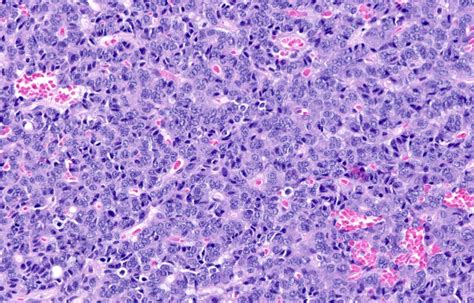 Pathology Outlines - Typical carcinoid tumor / neuroendocrine tumor, grade 1