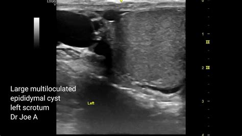 Large multiloculated epididymal cyst upper pole testis ultrasound of ...