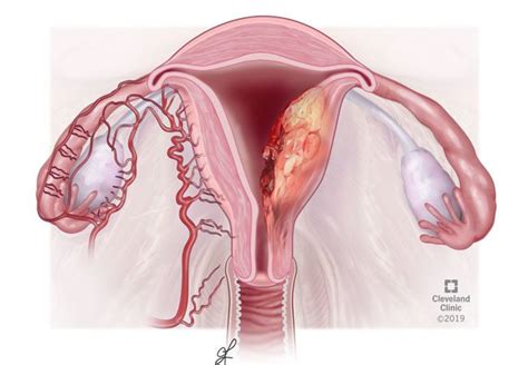 Endometrial Cancer, Everything you should know - Oncoplus Hospital