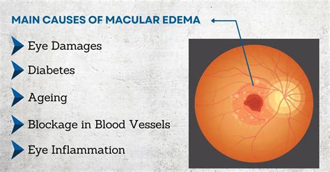 Cystoid Macular Edema (CME) Treatment in Delhi | Causes & Prevention