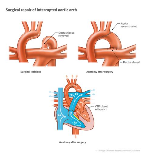 Aortic Valve: Aortic Valve Function And Location