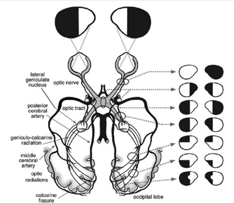 Figure 2 from Visual field defects after stroke--a practical guide for ...