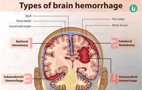 Brain Hemorrhage: symptoms, causes, treatment, medicine, prevention ...