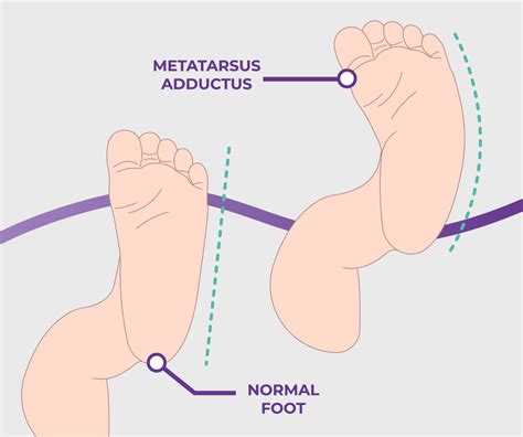 Metatarsus Adductus: Causes, Symptoms & Treatment