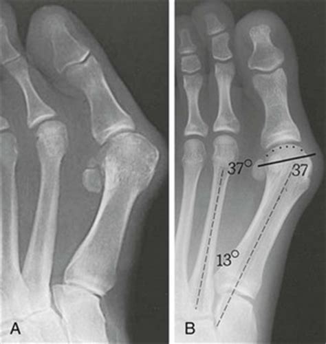 Hallux Valgus | Musculoskeletal Key