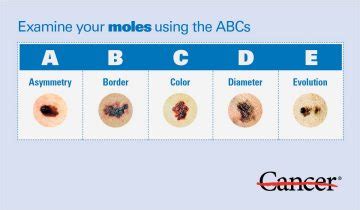 Melanoma Skin Moles