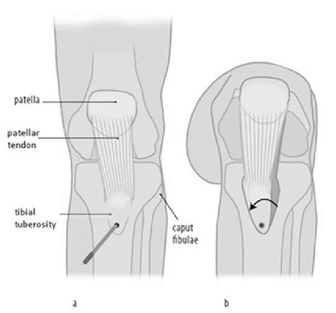 Patella And Tibial Tuberosity