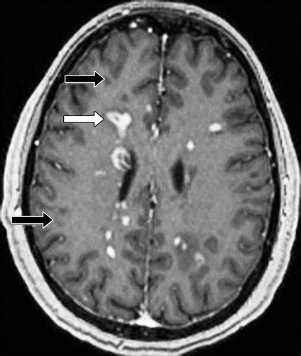 White Matter Diseases with Radiologic-Pathologic Correlation | RadioGraphics