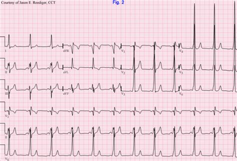 Delta wave | ECG Guru - Instructor Resources