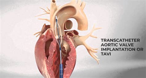 What You Need to Know About Transcatheter Aortic Valve Implantation or TAVI : Eternal Hospital