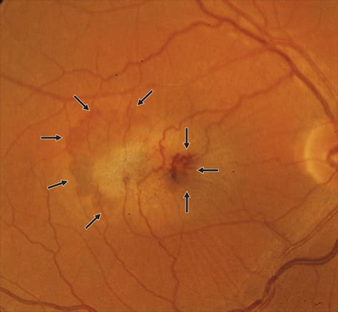 Idiopathic Macular Telangiectasia | Cardiology | JAMA Ophthalmology | The JAMA Network