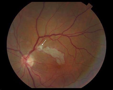 Moran CORE | Fundus Photography and Fluorescein Angiography of Branch Retinal Artery Occlusion