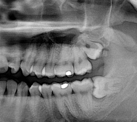 What is an Impacted Tooth?