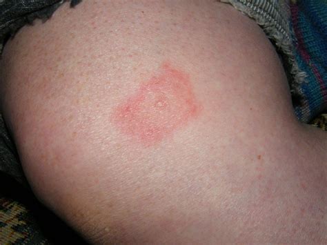 Lyme disease | Tick bite showing lyme disease rash | Chris Booth | Flickr