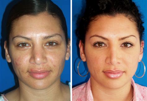 Pug nose rhinoplasty /where can i go to get affordable rhinoplasty in mass/