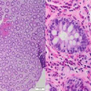 CT scan image of Case 1. The fecal impaction and intestinal pneumatosis... | Download Scientific ...