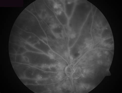 Severe Nonproliferative Diabetic Retinopathy With Capillary Nonperfusion - Retina Image Bank