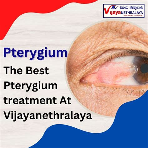 Pterygium Eye Treatment: Understanding Causes Symptoms