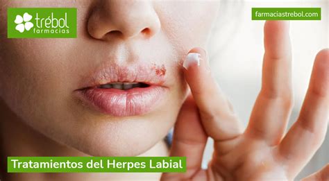 Tratamientos del herpes labial | Farmacias Trébol