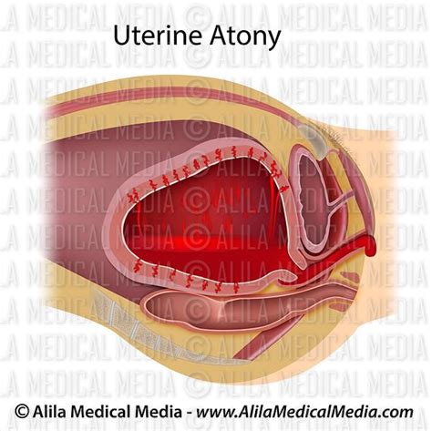 Alila Medical Media | Uterine atony, lying down position | Medical ...