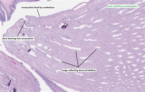 Kidney Biopsy of the Month- The Tubulointerstitium Part 2: The Medulla - Renal Fellow Network