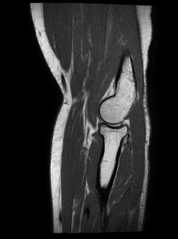 Elbow MRI Sagittal Lateral View Diagram | Quizlet