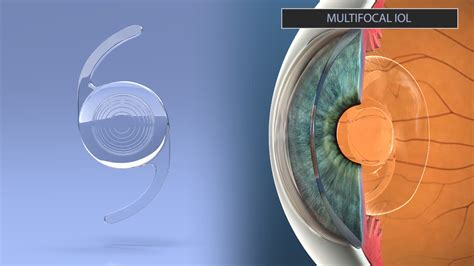 Selecting an Intraocular Lens (IOL) - Ophthalmic Consultants of Vermont