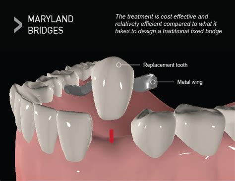 Cantilever Dental Bridge